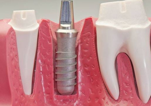 Alot Montes, Dr. Jorge implantes dentales